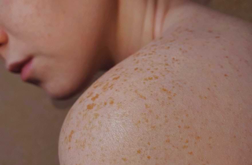 ragazza con le lentiggini sulla schiena