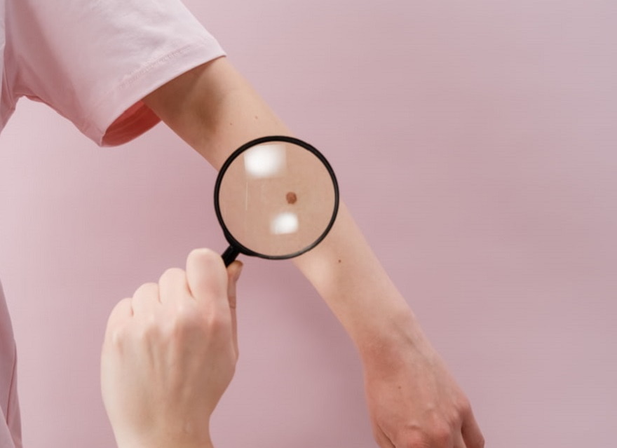 Effettuare una visita dermatologica prima di iniziare il trattamento